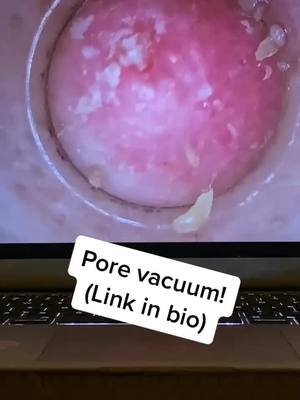 A post by @porevacuumplug on TikTok caption: Pore vacuums available at link in bio! #porevacuum #pores #foryoupage #fyp #viral