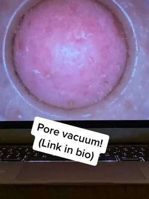 A post by @porevacuumplug on TikTok caption: Pore vacuums available at link in bio! #porevacuum #pores #foryoupage #fyp #viral