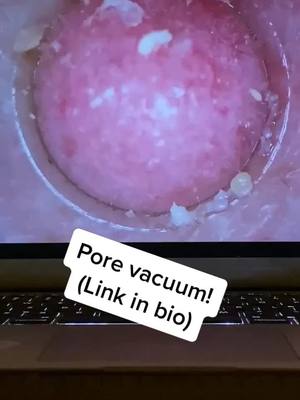 A post by @porevacuumplug on TikTok caption: Pore vacuums available at link in bio! #porevacuum #pores #foryoupage #fyp #viral