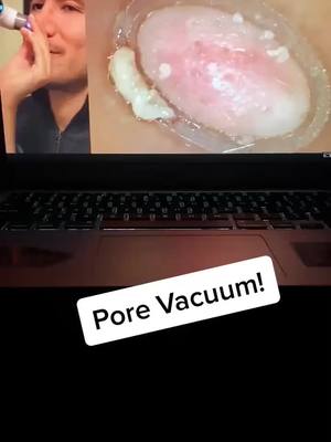 A post by @porevacuumplug on TikTok caption: You can get your own pore vacuum for a great price, link in bio! #pore #porevacuum #fyp #foryou #usa