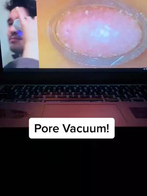 A post by @porevacuumplug on TikTok caption: You can get your own pore vacuum for a great price, link in bio! #pore #porevacuum #fyp #foryou #usa