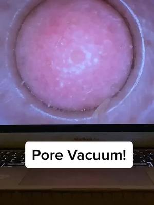 A post by @porevacuumplug on TikTok caption: You can get your own pore vacuum for a great price, link in bio! #pore #porevacuum #fyp #foryou #usa