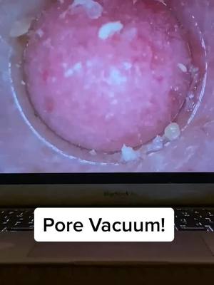 A post by @porevacuumplug on TikTok caption: You can get your own pore vacuum for a great price, link in bio! #pore #porevacuum #fyp #foryou #usa