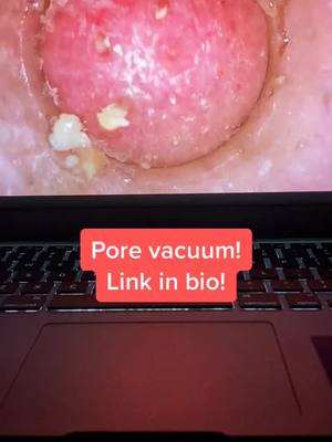 A post by @poresvacuum on TikTok caption: Pore vacuum! Link in bio!#porevacuum #foryoupage #fyp #viral #usa #america #xyzbca