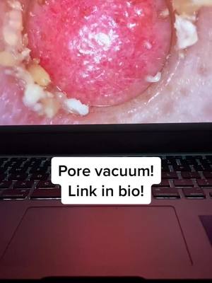 A post by @poresvacuum on TikTok caption: Pore vacuum! Link in bio!#porevacuum #foryoupage #fyp #viral #usa #america #xyzbca