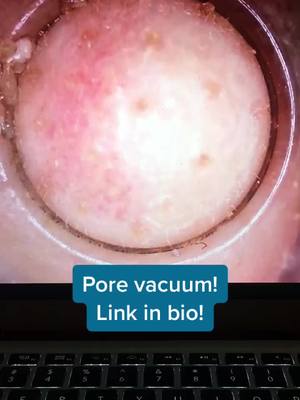 A post by @poresvacuum on TikTok caption: Pore vacuum! Link in bio!#porevacuum #foryoupage #fyp #viral #usa #america #xyzbca