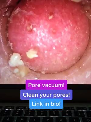 A post by @porevacuumplug on TikTok caption: Pore vacuum! Link in bio!#porevacuum #foryoupage #fyp #viral #usa #america #xyzbca