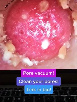 A post by @porevacuumplug on TikTok caption: Pore vacuum! Link in bio!#porevacuum #foryoupage #fyp #viral #usa #america #xyzbca