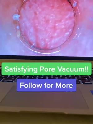 A post by @pore.vacuum.plug on TikTok caption: Pore vacuum! Link in bio!#porevacuum #foryoupage #fyp #viral #usa #america #xyzbca