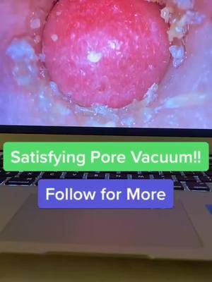 A post by @pore.vacuum.plug on TikTok caption: Pore vacuum! Link in bio!#porevacuum #foryoupage #fyp #viral #usa #america #xyzbca