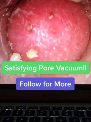 A post by @pore.vacuum.plug on TikTok caption: Pore vacuum! Link in bio!#porevacuum #foryoupage #fyp #viral #usa #america #xyzbca