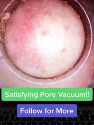 A post by @pore.vacuum.plug on TikTok caption: Pore vacuum! Link in bio!#porevacuum #foryoupage #fyp #viral #usa #america #xyzbca