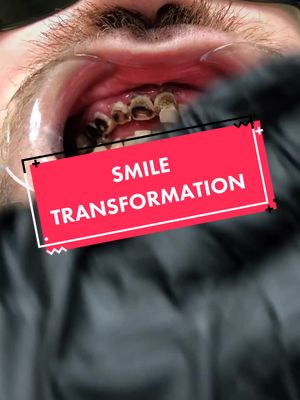 A post by @brandonmeck on TikTok caption: Giving amazing people the smiles they deserve 😁 #smilemakeover #dentist #beforeandafter