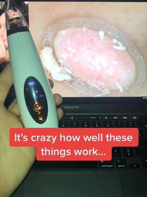 A post by @pore.vacuum.plug on TikTok caption: You can get your own pore vacuum, link in bio! #porevacuum #pore #skin #skincare #beauty #makeup