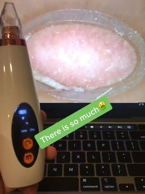 A post by @pore.vacuum.plug on TikTok caption: You can get your own pore vacuum, link in bio! #porevacuum #pore #skin #skincare #beauty #makeup