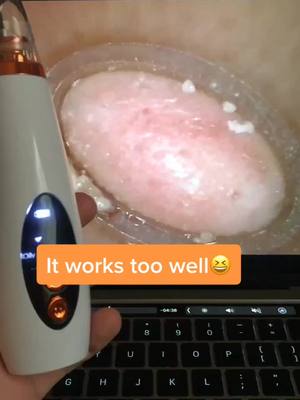 A post by @pore.vacuum.plug on TikTok caption: You can get your own pore vacuum, link in bio! #porevacuum #pore #skin #skincare #beauty #makeup