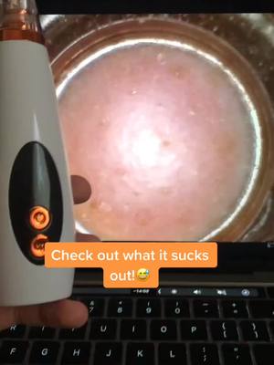 A post by @pore.vacuum.plug on TikTok caption: You can get your own pore vacuum, link in bio! #porevacuum #pore #skin #skincare #beauty #makeup