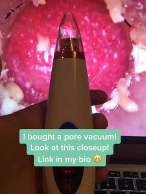 A post by @porevacuum.us on TikTok caption: Pore vacuums available at link in bio! #porevacuum #pores #viral #fyp