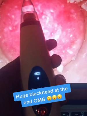 A post by @porevacuum.us on TikTok caption: Pore vacuums available at link in bio! #porevacuum #pores #viral #fyp