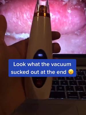 A post by @porevacuum.us on TikTok caption: Pore vacuums available at link in bio! #porevacuum #pores #viral #fyp