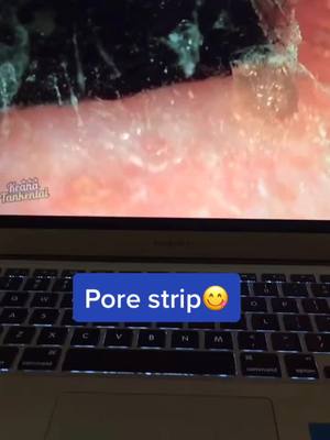 A post by @porevacuum.us on TikTok caption: Pore vacuums available at link in bio! #porevacuum #pores #viral #fyp