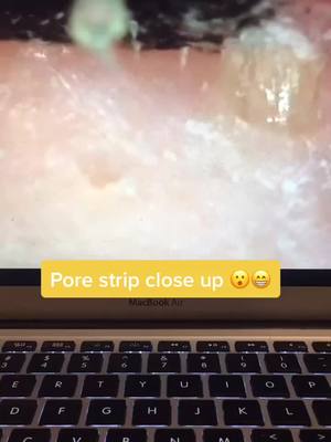 A post by @poresvacuum on TikTok caption: Pore strips available at link in bio! #porevacuum #pores #viral #fyp