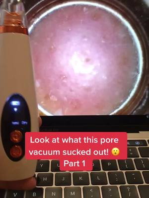 A post by @porevacuum.skincare on TikTok caption: Pore vacuums available at link in bio! #porevacuum #pores #viral #fyp