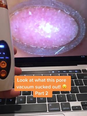 A post by @porevacuum.skincare on TikTok caption: Pore vacuums available at link in bio! #porevacuum #pores #viral #fyp