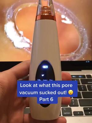 A post by @porevacuum.skincare on TikTok caption: Pore vacuums available at link in bio! #porevacuum #pores #viral #fyp