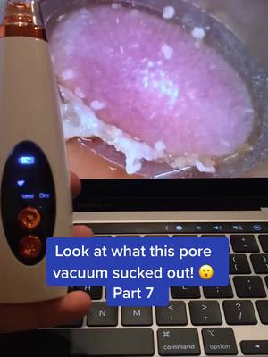 A post by @porevacuum.skincare on TikTok caption: Pore vacuums available at link in bio! #porevacuum #pores #viral #fyp