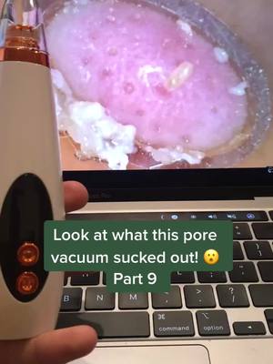 A post by @porevacuum.skincare on TikTok caption: Pore vacuums available at link in bio! #porevacuum #pores #viral #fyp