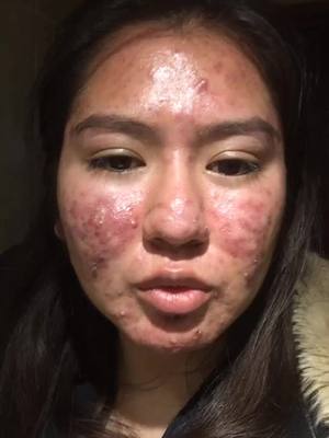 A post by @kimbjim_1010 on TikTok caption: Las otras partes están en mi cuenta#acne#paratiiii#fyp#acnestory #historiasdetiktok#storytimevideos#piel