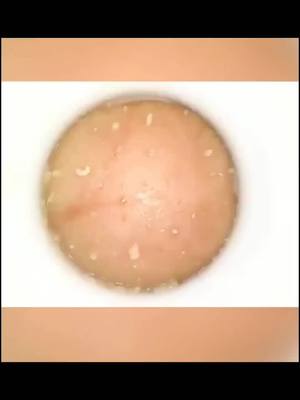 A post by @pcaress on TikTok caption: Do u know what is this? #pop #pimple #pore #skincare #pimplepopping