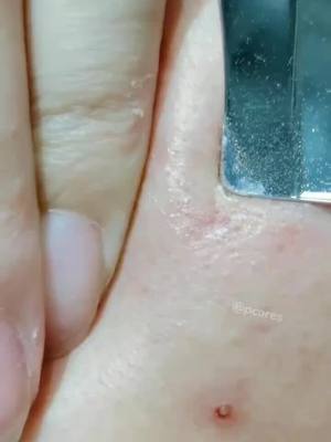 A post by @pcaress on TikTok caption: What'd coming out 😜#pimplepopping #ultrasonic #pimple #skincare #pores