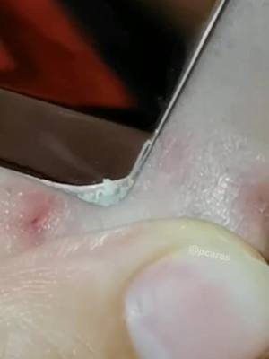 A post by @pcaress on TikTok caption: They are coming out. #extractions #pores #clogged #facecare #facecleaning