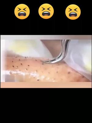 A post by @facecares on TikTok caption: WTF, #pores #facecare #pimple #popping #pop