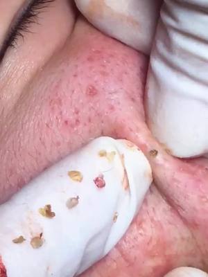 A post by @makeup.beautylady on TikTok caption: #pimple #pimples #pimplepop #pimplepopper #pimplepopping #satisfying#satisfy #fyp #foryou #makeup #makeupartist