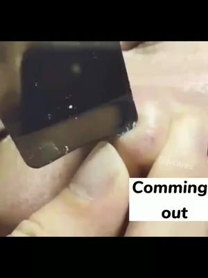 A post by @pcaress on TikTok caption: Annoying pores are being shaken out. 😤😤😤 #pores #facecare #pimple #extractions #ultrasonicscrubber