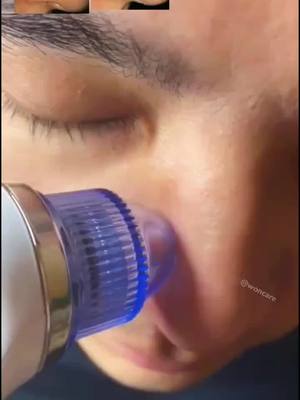 A post by @woncare on TikTok caption: Come to see BIO, purchase and try pore vacuum to save your beautiful  face.! #pimple #pores #pimplepopping #facecare #porevacuum