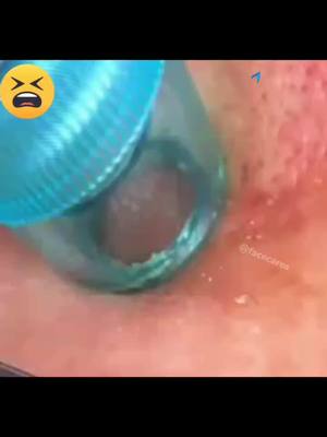 A post by @facecares on TikTok caption: What's being sucked out #pimple #facecare #porevacuum #skincare #pores