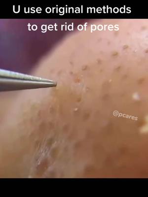 A post by @pcaress on TikTok caption: Will u clear pores in other ways #ThinkingAbout #fypp #pimple #facecare #pores #extractions