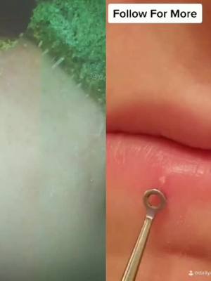 A post by @pcaress on TikTok caption: #duet with @dailydoseofpimppopping   Clear, which is better #pores #extractions #acne #thinkingabout #foryou