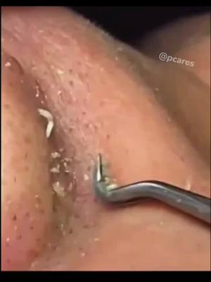 A post by @pcaress on TikTok caption: Like or not? #pop #extractions #pores #clogged #pimples