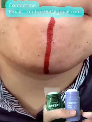 A post by @acbnm2 on TikTok caption: There is a link on my homepage to get the products in the video.Now with 50% discount，#Acne Removal #Improve Skin#Acne