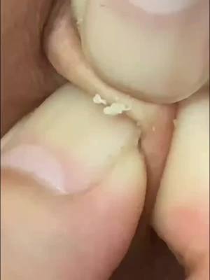 A post by @woncare on TikTok caption: Did it right? #Homemade #pores #acne #popping #pimple