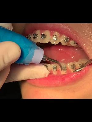 A post by @smiling_clinicadental04 on TikTok caption: #dentista #mty #clínicadental #limpieza #ortodoncia # brackets #sonrisa #smiling