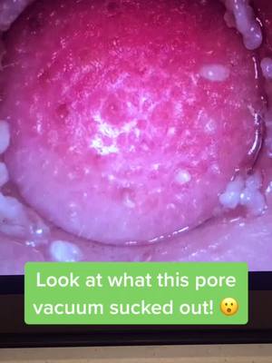 A post by @porevacuum.skincare on TikTok caption: Pore vacuums available at link in bio! #porevacuum #pores #viral #fyp