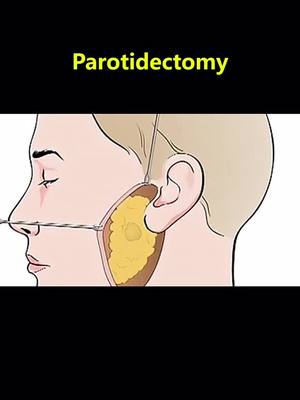 A post by @surgicalanimation on TikTok caption: #foryou #surgery #doctorsoftiktok #parotidectomy #hurt  #face #fypシ