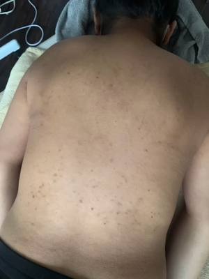 A post by @facebeautyspa on TikTok caption: Summer is around the corner..    how’s your back looking? #backfacial #memphisfacial #atlantafacial