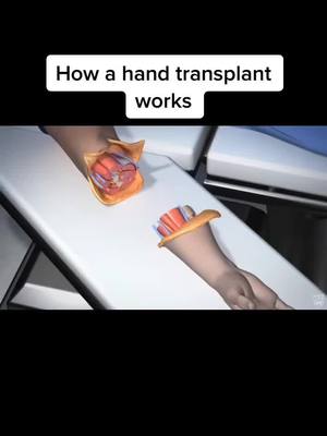 A post by @interestinggggggggggggg on TikTok caption: How a hand transplant works Credits: Drugs.com #handtransplant #transplant #surgery #medical #fy